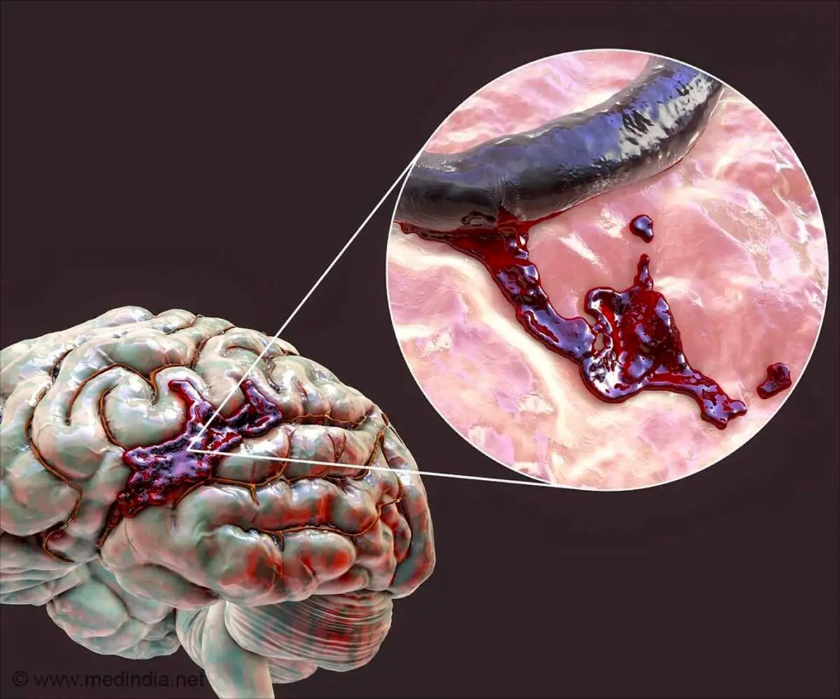 خونریزی مغزی چه علائمی دارد؟