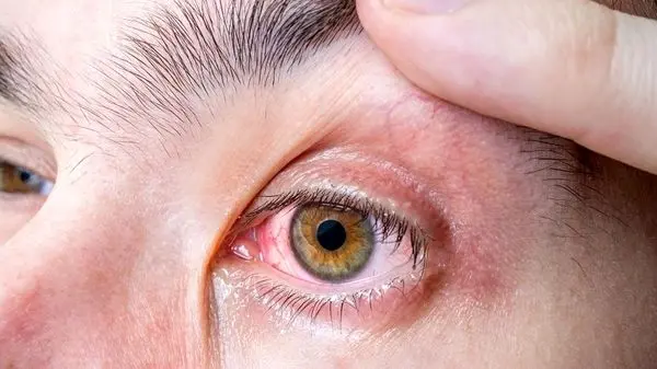 با شایع‌ترین بیماری‌های چشم آشنا شوید + توصیه مهم برای سلامت چشم‌ها