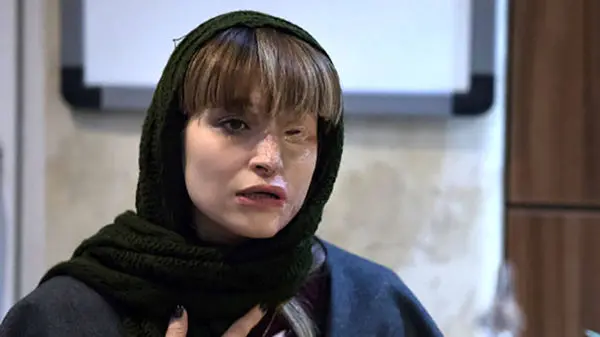 واکنش دردناک دختر زیبای قربانی اسیدپاشی به بیلبوردهای شهرداری