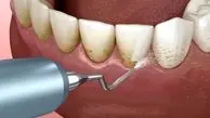 آیا جرم‌گیری برای دندان مفید است؟