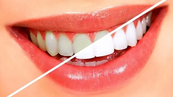 با کمبود این ویتامین دچار پوسیدگی دندان می‌شوید!