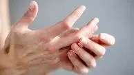 تشخیص اولیه سرطان از روی شکل انگشتان دست!