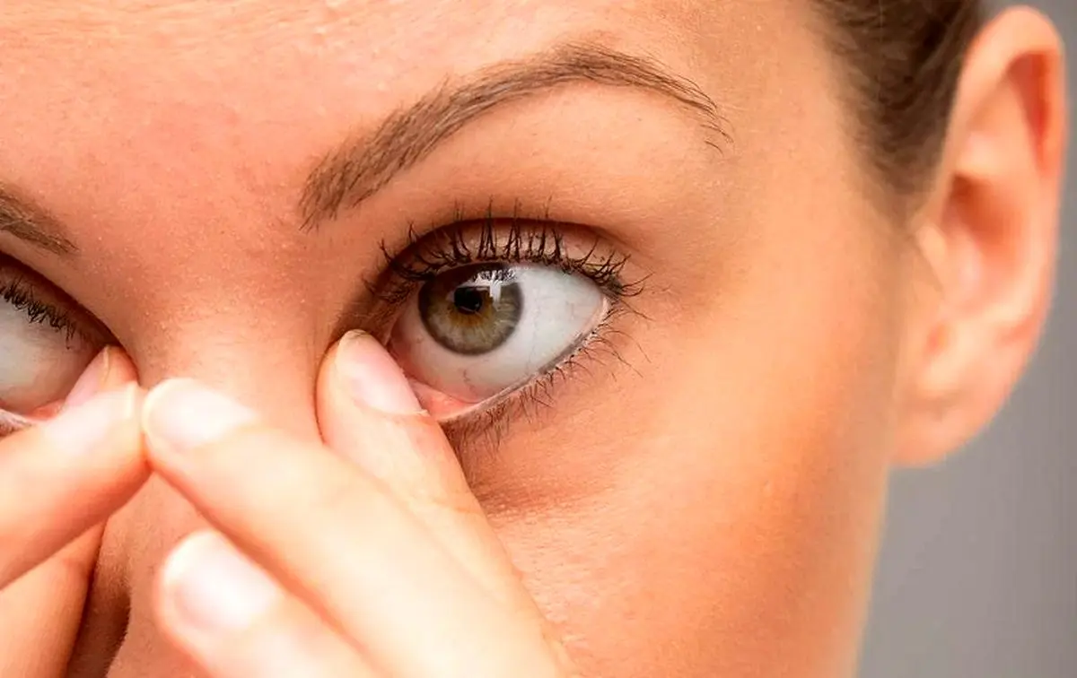 چگونه علائم بیماری کبد را از چشمانمان تشخیص دهیم؟