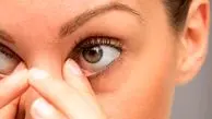 بهترین درمان خشکی چشم کدام است؟