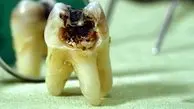 چرا دندان‌‌‌‌‌‌‌‌‌‌ ایرانی‌ها اغلب خراب است؟