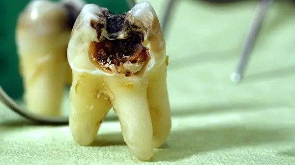 آیا جرم‌گیری برای دندان مفید است؟