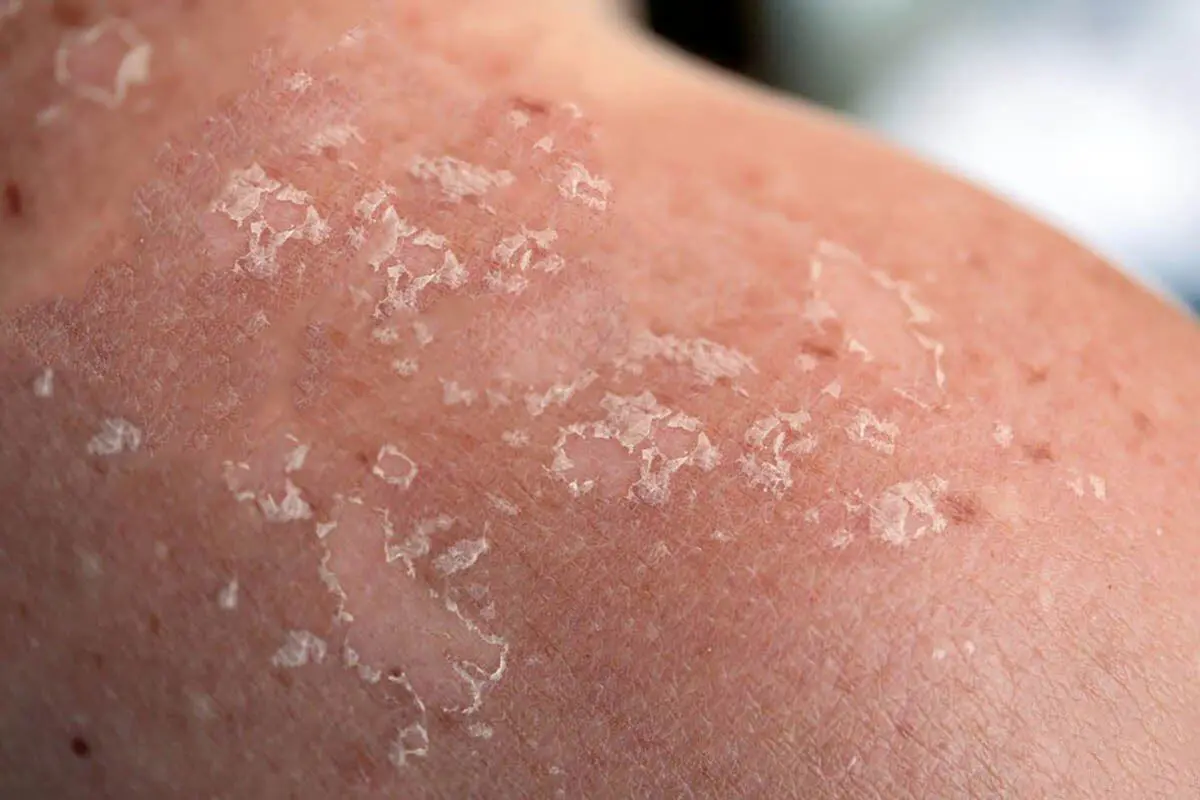 کدام نوع سرطان پوستی خطرناک‌تر است؟