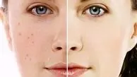 روش‌های ساده برای درمان جوش‌های صورت
